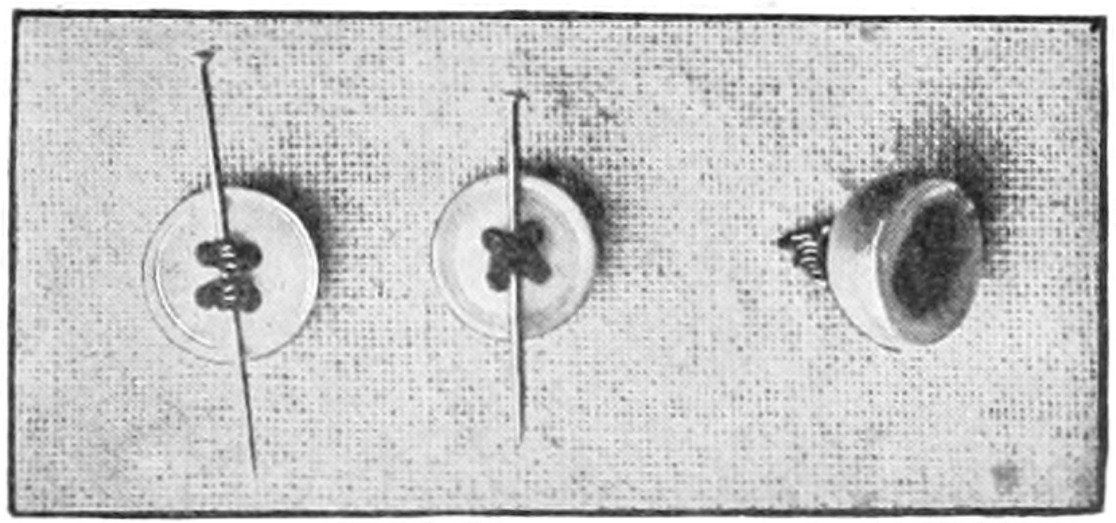 Sewing on buttons for shirt and dress button closure assembly.